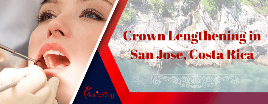 Important Information on Crown Lengthening in San Jose, Costa Rica